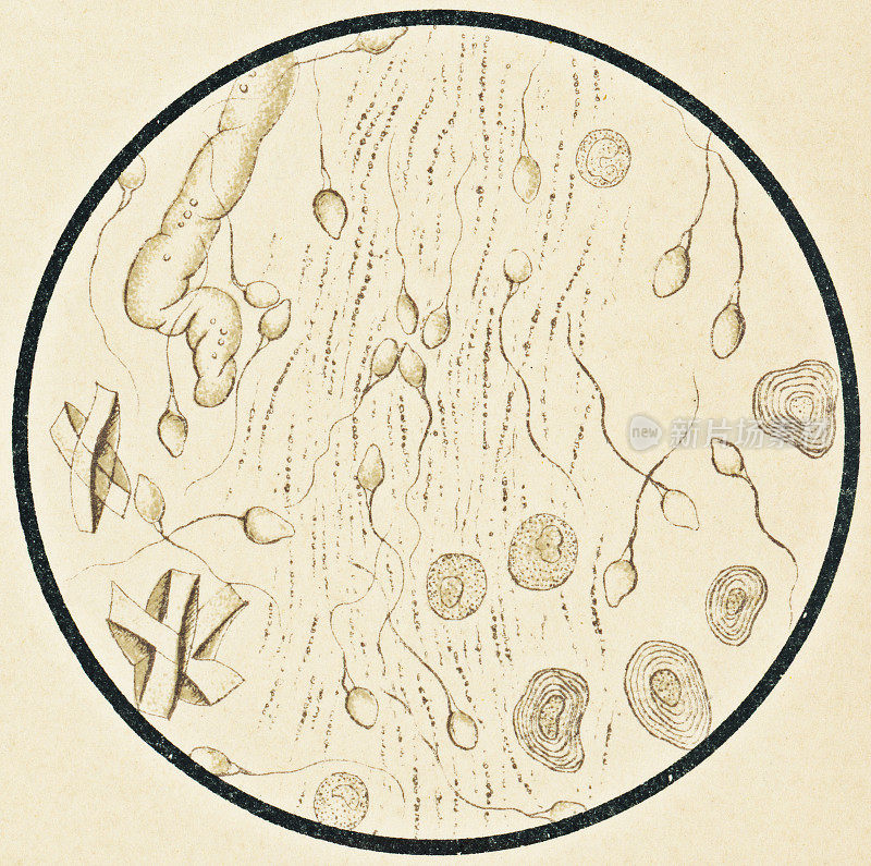 人类精子和支持细胞的显微镜观察- 19世纪